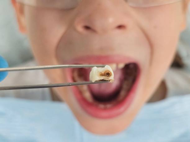 Best Knocked-Out Tooth Emergency  in Newcastle, WA